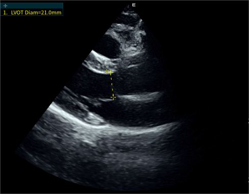 Auto LVOT-D左室流出道直徑自動測量